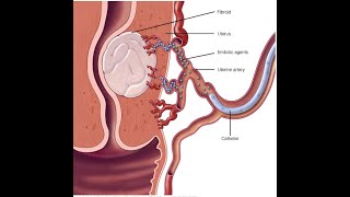 Uterine Adenomyosis  Diagnosis amp Treatment [upl. by Kermie912]