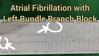 Atrial Fibrillation with Left Bundle Branch Block on ECG [upl. by Amilas297]