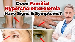 Does Familial Hypercholesterolemia Have Signs amp Symptoms [upl. by Fayette]