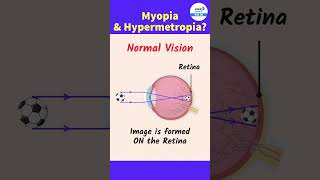 Myopia and Hypermetropia  Class 10 Physics  shorts imageformation  InfinityLearn910 [upl. by Ilonka]