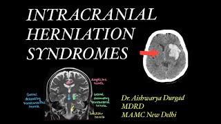 Intracranial herniation syndromes Imaging review  Relevant Anatomy [upl. by Ahsielat]