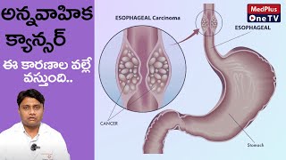 Esophageal Cancer Causes and Symptoms  DrManjunath Bale MedPlusONETV [upl. by Gone499]