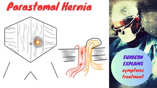 Parastomal Hernia Symptoms and Treatment [upl. by Player]