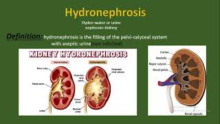 Hydronephrosis Definition causes and etiology pathology types diagnosis treatment [upl. by Aisanahta]