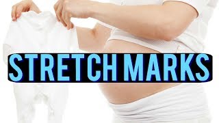 HOW TO  Prevent Stretch Marks During pregnancy🤰🤰 [upl. by Shere163]