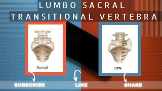 LUMBOSACRAL TRANSITIONAL VERTEBRAE  LSTV  LUMBARIZATION  SACRALIZATION  BERTOLOTTI SYNDROME [upl. by Neau]