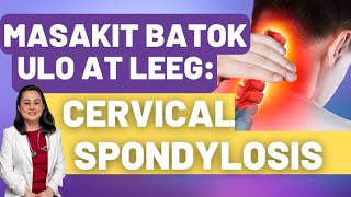 Masakit ang Batok Ulo at Leeg Cervical Spondylosis  By Doc Liza RamosoOng [upl. by Carla]