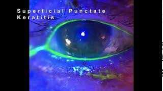 Superficial Punctate Keratitis SPK [upl. by Elcarim]