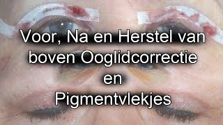 Review Boven Ooglidcorrectie en Ervaring Pigmentvlekjes verwijderen [upl. by Leinoto]