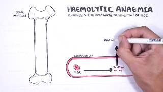 Haemolytic Anaemia  classification intravascular extravascular pathophysiology investigations [upl. by Renata]