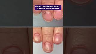 Nail Fungus Try This 3 Ingredient Fix nailfungus nailfungustreatment diynailcare [upl. by Buhler]