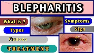 BLEPHARITIS  চোখের পাতায় খুশকি  কেন হয় মুক্তির উপায় কি [upl. by Byrne]