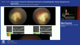 4 Fungal endophthalmitis – how is it different [upl. by Alym]