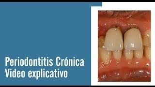 Periodontitis Crónica  Juan Salgado  Enfermedades Periodontales  Video explicativo [upl. by Nnaillek]