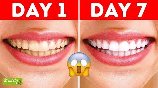 Get Instantly Whiter Teeth in 2 Minutes Try This Simple Hack Now [upl. by Arta216]