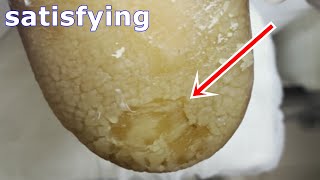 Cracked heels treatment amp Callus removal  Dead skin removal and Cracked heels treatment part 2 [upl. by Nerot]