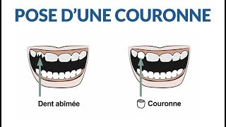 Comment le dentiste poseil une couronne [upl. by Ortrude]