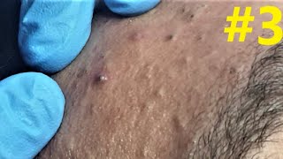 BLACKHEADS EXTRACTIONS on Happys Forehead 3 [upl. by Montanez]