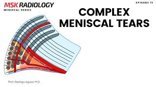 Complex Meniscal Tear on MRI [upl. by Calica300]