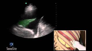 How To Ultrasound Guided Thoracentesis Exam 3D Video [upl. by Eiwoh]