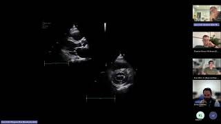 LV size function and haemodynamic assessment [upl. by Conan]