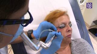 Eliminacion de siringomas milium y fibromas con laser [upl. by Yrtsed708]