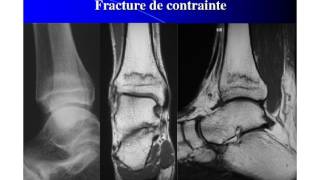 Imagerie médicale en pathologie sportive de l’enfant et de l’adolescent [upl. by Tamarra226]