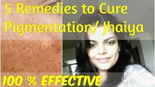 चेहरे की झाइयों का उपचार  Hyperpigmentation Causes Treatment Jhaiya on face Treatment in Hindi [upl. by Immaj]