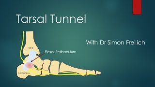 Tarsal Tunnel Syndrome [upl. by Ayerhs77]