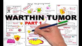 Warthin Tumor Salivay Gland Neoplasm  part 1 [upl. by Nalym617]