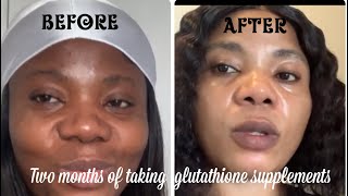 My journey with glutathione Supplements￼ [upl. by Savitt530]