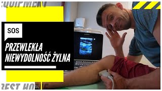 Zmęczone i ciężkie nogi Przewlekła niewydolność żylna czyli pajączki żylaki i inne takie [upl. by Elke]