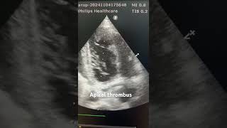 Apical thrombus echocardiography cardiacimaging cardiology [upl. by Hasile998]