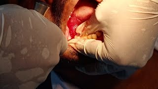 Lower wisdom tooth extraction subscribe support like [upl. by Naji]