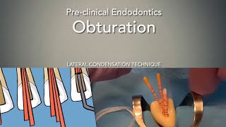 Obturation Lateral Condensation Technique [upl. by Zailer]