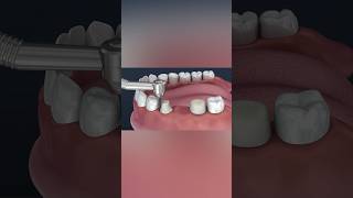 Tooth supported fixed bridge of 3 teeth medicalanimation health dentist [upl. by Ancell]