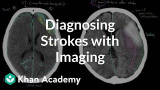 Diagnosing strokes with imaging CT MRI and Angiography  NCLEXRN  Khan Academy [upl. by Ahsi]