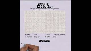 ANSWER ECG QUIZ DAY 2 [upl. by Nereids523]