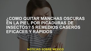 ¿Cómo eliminar las manchas oscuras en la piel después de las picaduras de insectos 5 remedios caser [upl. by Olney]