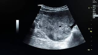 ovarian torsion ultrasound case [upl. by Konopka]