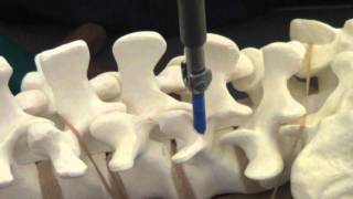 APSS Workshop Video 1 Lumbar Pedicle Screw and S1 Screw [upl. by Regnij]