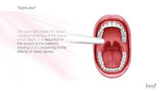 NightLase laser for snoring and sleep apnea [upl. by Aihsatan]