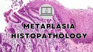 METAPLASIA  HISTOPATHOLOGY AND MORPHOLOGY [upl. by Yantruoc]