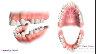 4 First Premolar Extraction for Retraction  Orthodontic Treatment [upl. by Maurie]