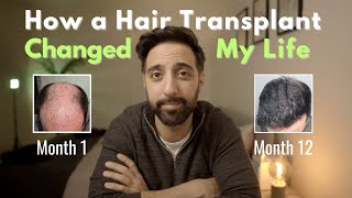 How Two Hair Transplants Changed My Life [upl. by Brasca641]