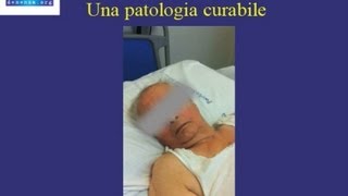 Diagnosi e trattamento Idrocefalo Normoteso  caso clinico [upl. by Notsrik189]