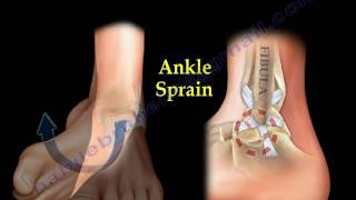 Ankle Pain ankle ligaments sprain  Everything You Need To Know  Dr Nabil Ebraheim [upl. by Aiekal]