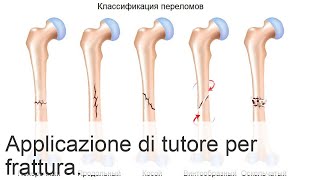 Immobilizzazione frattura femore articolazioni da fissare quando e perché [upl. by Auhsot742]