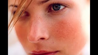 10 facts about rosacea [upl. by Lap]