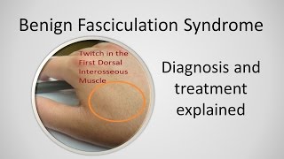 Benign Fasciculation Syndrome Causes and Treatment [upl. by Carlin]